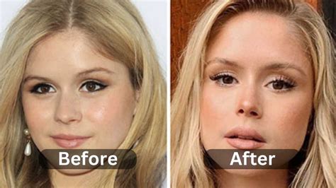 erin moriarty after surgery|Starlight Actress Erin Moriartys Plastic Surgery。